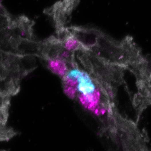 Tumor cell (blue) covered in platelets (magenta)