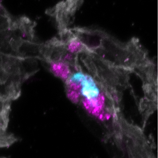 ANGIOPOIETIN-1 AND TUMOR METASTASIS